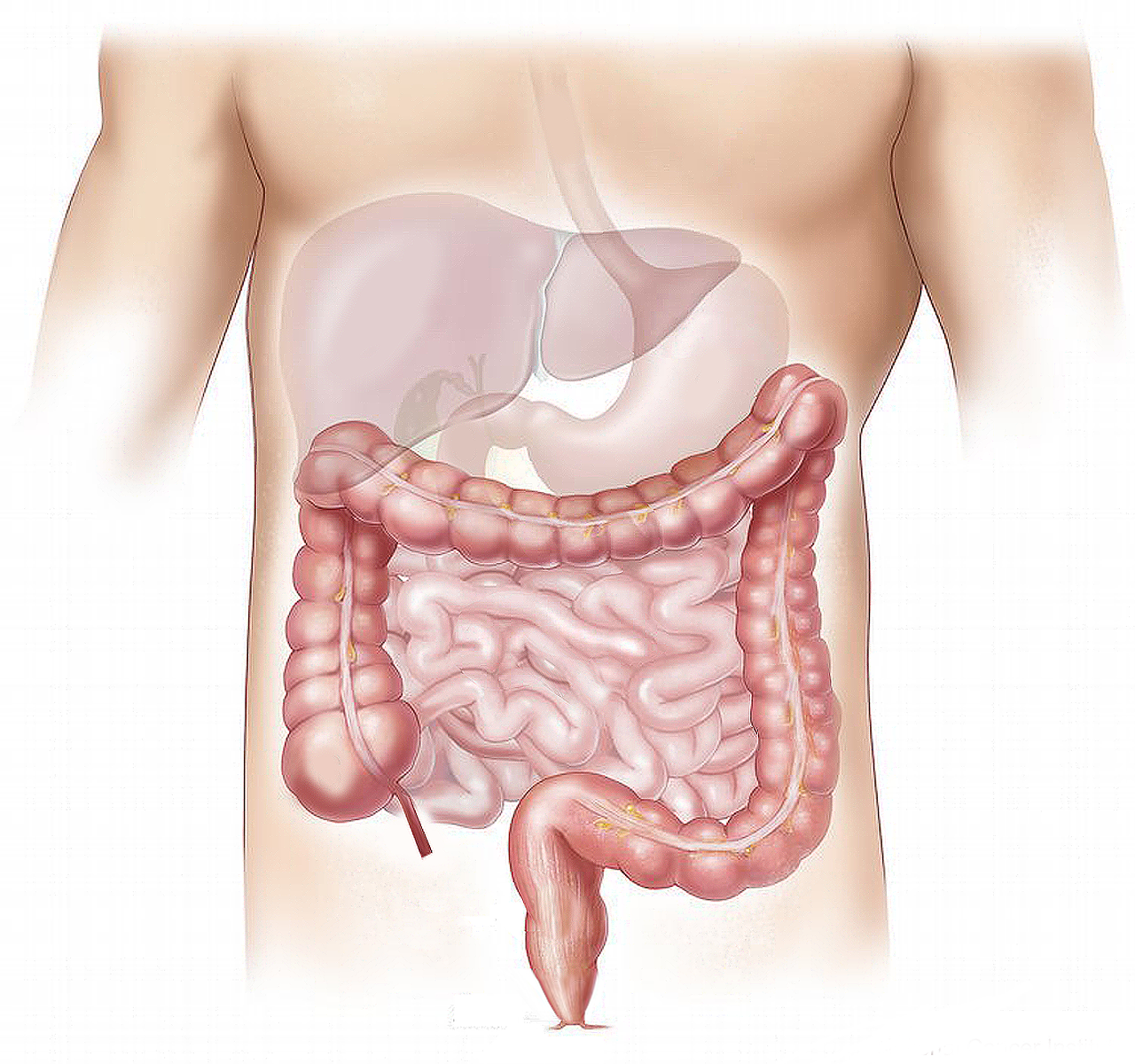 Cancer colorectal